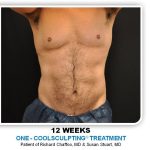 Coolsculpting Before & After Patient #4830