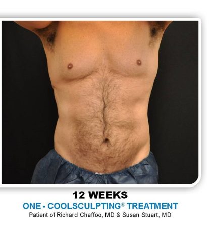 Coolsculpting Before & After Patient #4830