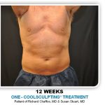 Coolsculpting Before & After Patient #4837