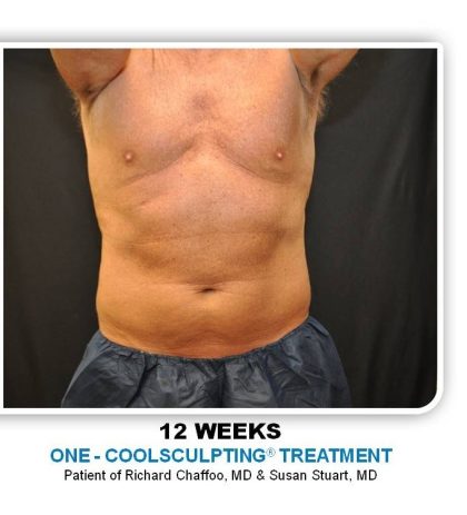 Coolsculpting Before & After Patient #4837