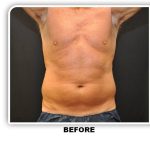 Coolsculpting Before & After Patient #4837