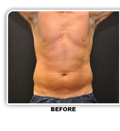 Coolsculpting Before & After Patient #4837