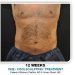 Coolsculpting Before & After Patient #4842