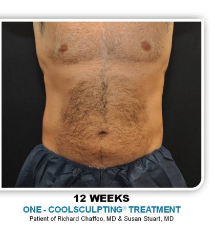 Coolsculpting Before & After Patient #4842