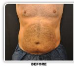 Coolsculpting Before & After Patient #4842