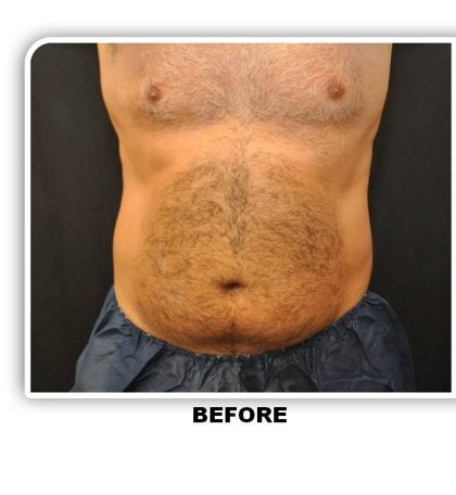 Coolsculpting Before & After Patient #4842