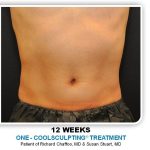 Coolsculpting Before & After Patient #4845
