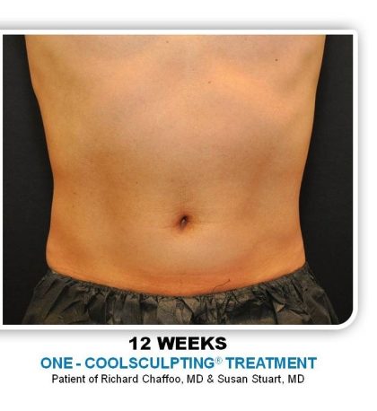 Coolsculpting Before & After Patient #4845