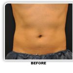 Coolsculpting Before & After Patient #4845