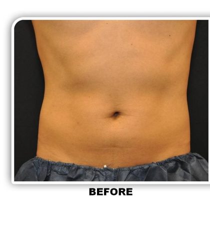 Coolsculpting Before & After Patient #4845