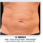 Coolsculpting Before & After Patient #4848