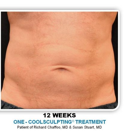 Coolsculpting Before & After Patient #4848