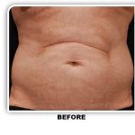 Coolsculpting Before & After Patient #4848