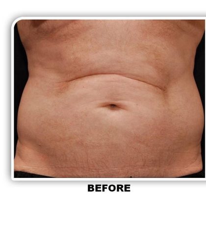 Coolsculpting Before & After Patient #4848