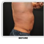 Coolsculpting Before & After Patient #4857