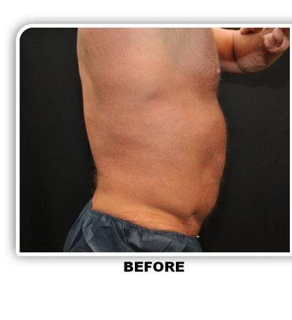 Coolsculpting Before & After Patient #4857