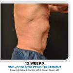 Coolsculpting Before & After Patient #4857