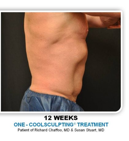 Coolsculpting Before & After Patient #4857