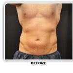 Coolsculpting Before & After Patient #4857