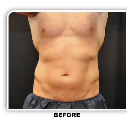 Coolsculpting Before & After Patient #4857