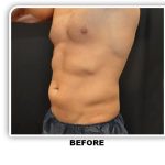 Coolsculpting Before & After Patient #4857