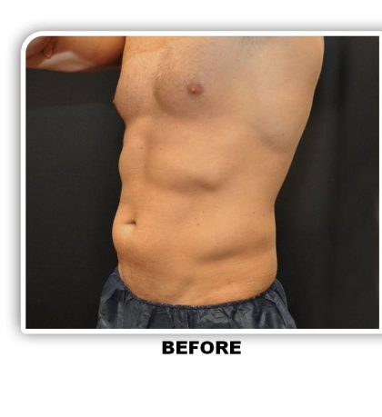 Coolsculpting Before & After Patient #4857