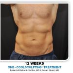 Coolsculpting Before & After Patient #4857