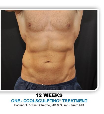 Coolsculpting Before & After Patient #4857