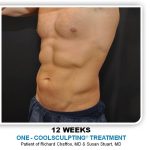 Coolsculpting Before & After Patient #4857