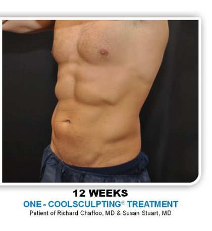 Coolsculpting Before & After Patient #4857