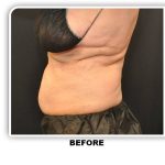 Coolsculpting Before & After Patient #4858