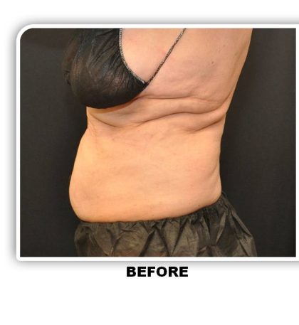 Coolsculpting Before & After Patient #4858