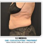 Coolsculpting Before & After Patient #4858