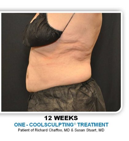 Coolsculpting Before & After Patient #4858