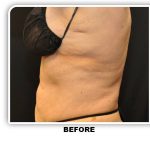 Coolsculpting Before & After Patient #4863