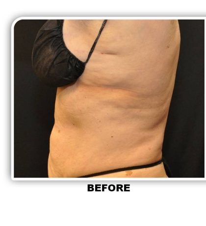 Coolsculpting Before & After Patient #4863