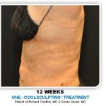 Coolsculpting Before & After Patient #4863