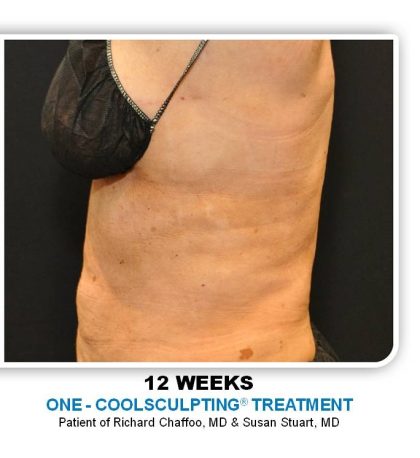 Coolsculpting Before & After Patient #4863