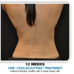 Coolsculpting Before & After Patient #4866