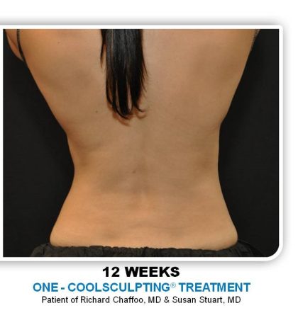Coolsculpting Before & After Patient #4866