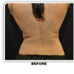 Coolsculpting Before & After Patient #4866