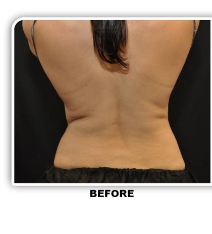 Coolsculpting Before & After Patient #4866