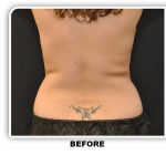 Coolsculpting Before & After Patient #4869