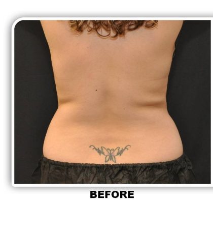 Coolsculpting Before & After Patient #4869