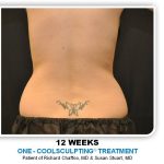 Coolsculpting Before & After Patient #4869