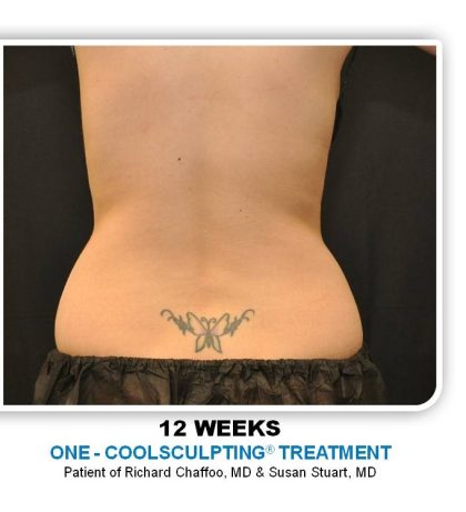 Coolsculpting Before & After Patient #4869