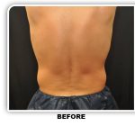 Coolsculpting Before & After Patient #4872