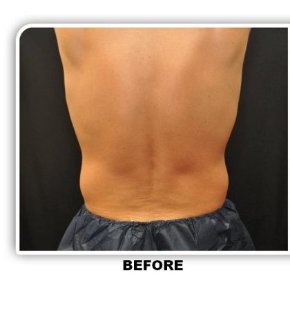 Coolsculpting Before & After Patient #4872