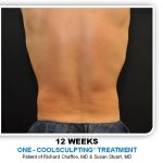 Coolsculpting Before & After Patient #4872