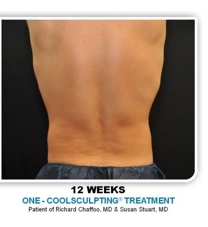 Coolsculpting Before & After Patient #4872